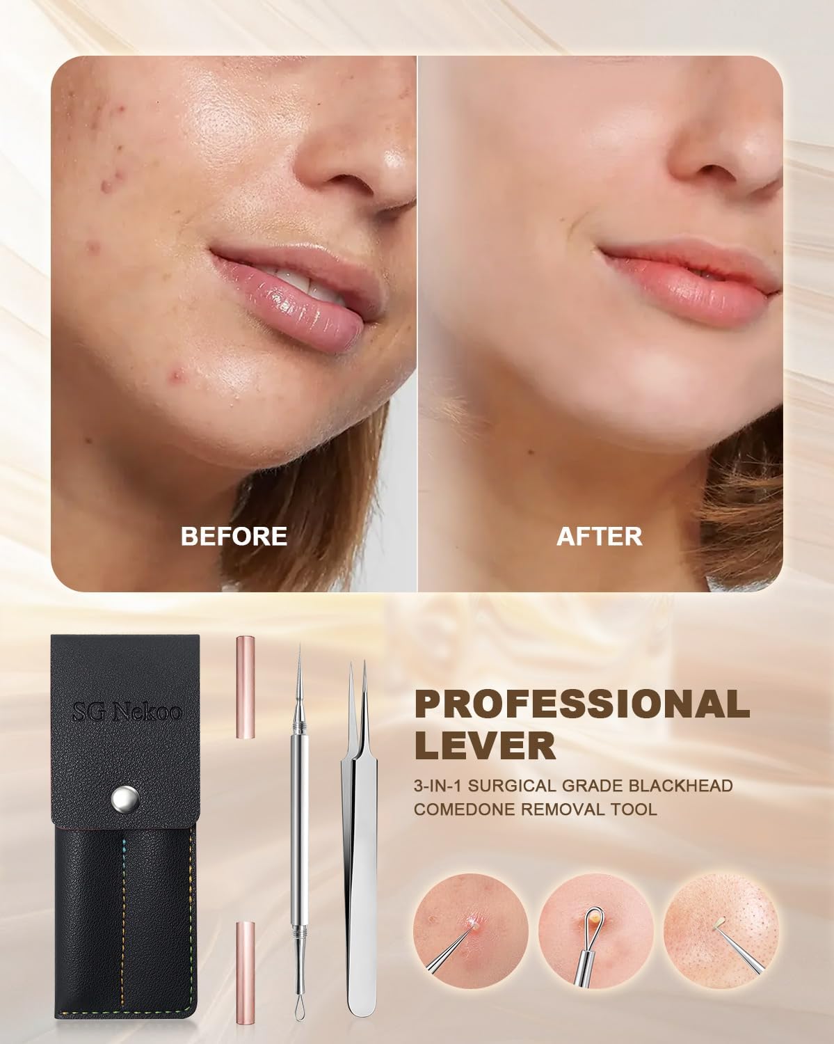 SGNEKOO Milia Remover Whitehead Extractor, Blackhead Tweezers with Angled Loop & Acne Needle Rose Gold in Case,Professional Facial Tool Kit