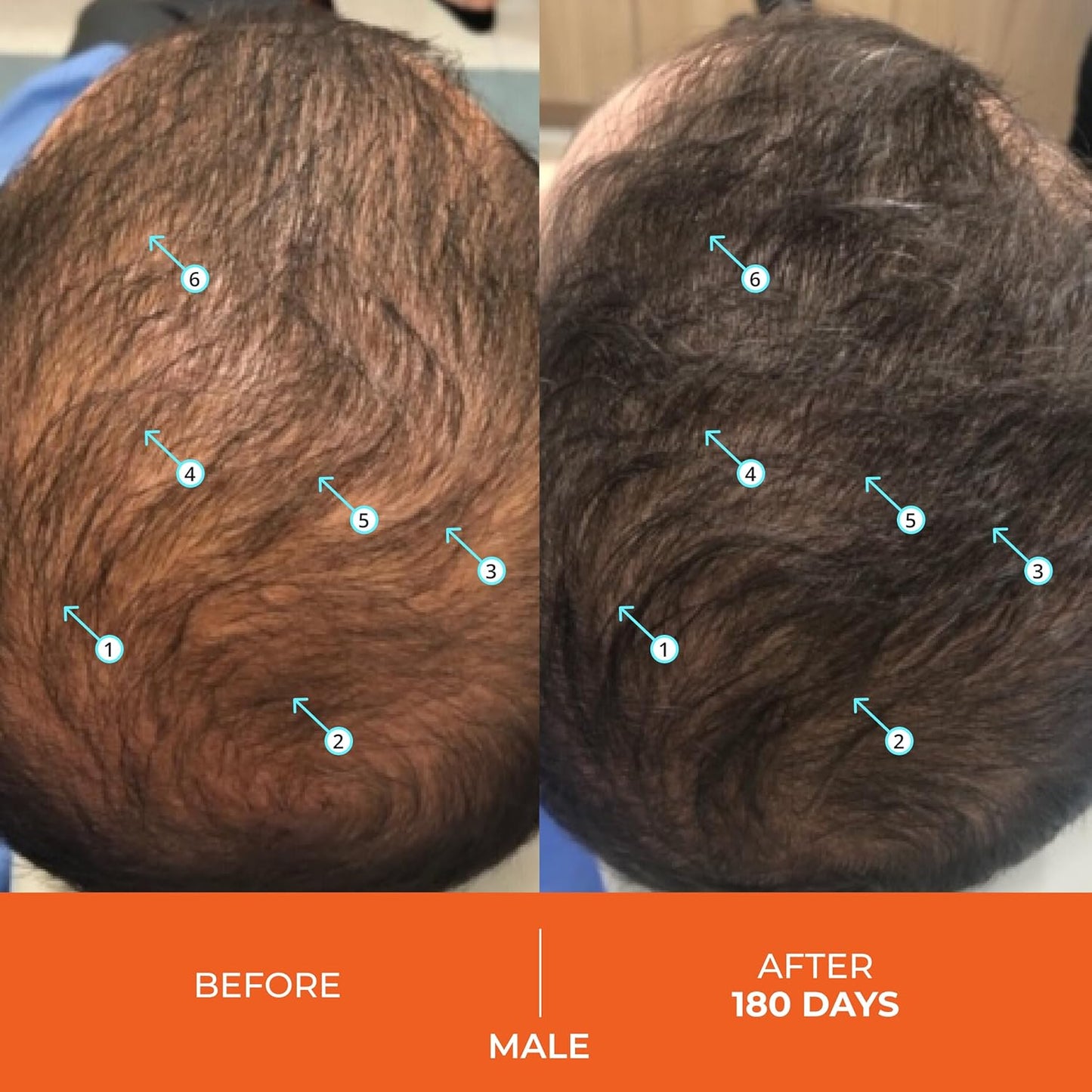 DS Labs Revita Hair Vitamin Gummies - Thickening & Strengthening Hair Supplement with Biotin, Zinc, Iron, Magnesium, Vitamin D & Melatonin, Fuller, Healthier-Looking Hair, Vegan & Gluten-Free